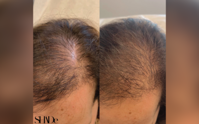 What Is The Best Method For Hair Restoration?