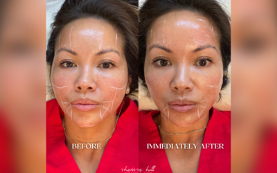 5 Reasons Why Ultherapy Is The Best Non-Surgical Facelift Option