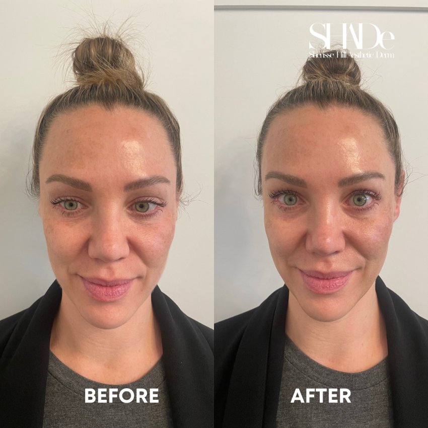 before and after facial treatment at sherisse hill aesthetic dermatology