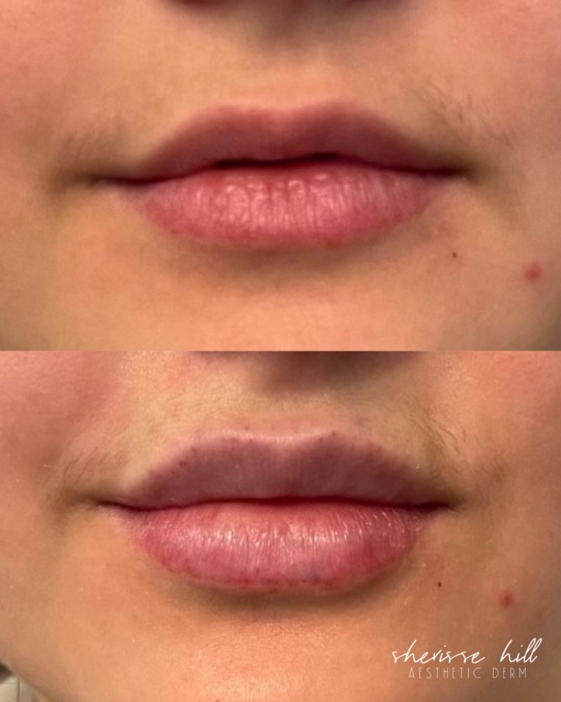 before and after dermal fillers at sherisse hill aesthetic dermatology