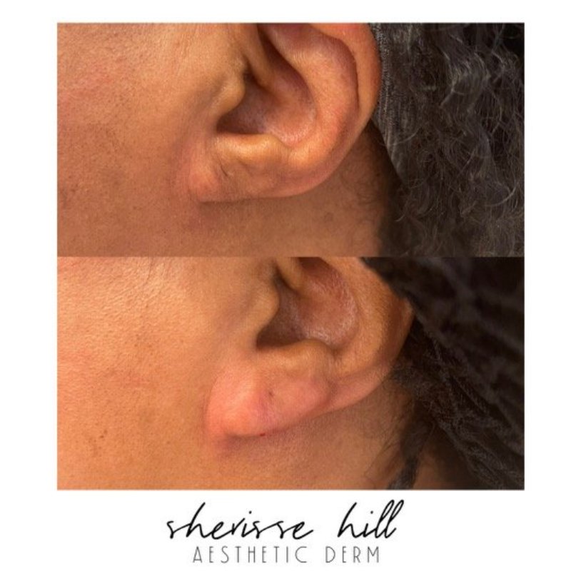 before and after dermal fillers at sherisse hill aesthetic dermatology