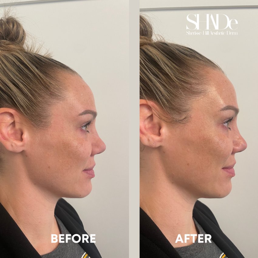 before and after facial treatment at sherisse hill aesthetic dermatology