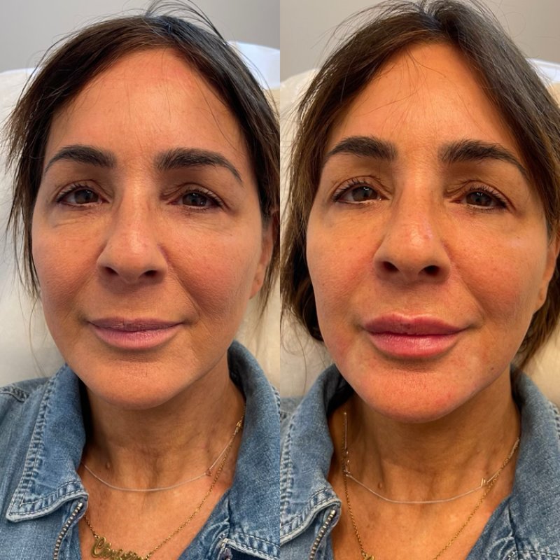 before and after dermal fillers at sherisse hill aesthetic dermatology