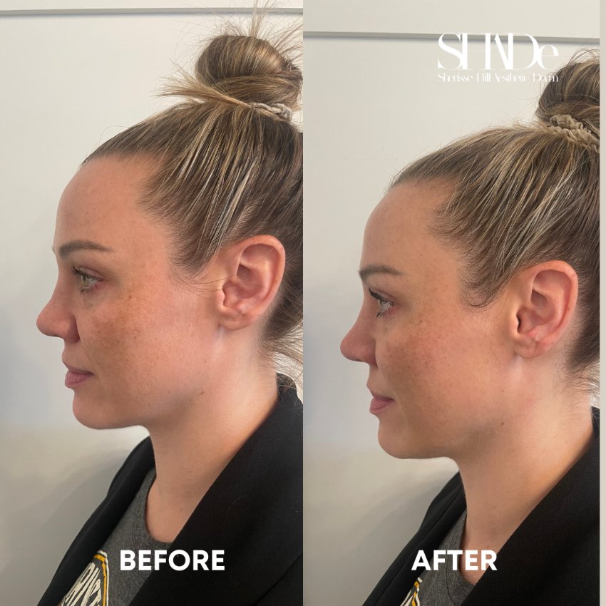 before and after facial treatment at sherisse hill aesthetic dermatology