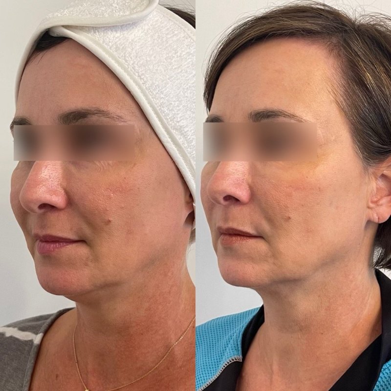 before and after silhouette instalift at sherisse hill aesthetic dermatology