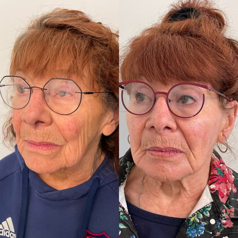 before and after dermal fillers at sherisse hill aesthetic dermatology