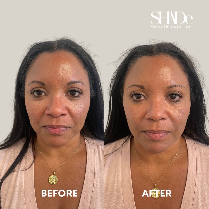 before and after facial treatment at sherisse hill aesthetic dermatology