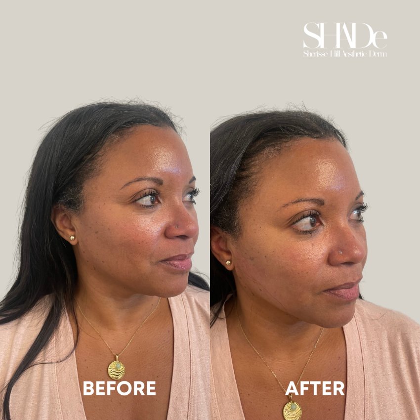before and after facial treatment at sherisse hill aesthetic dermatology