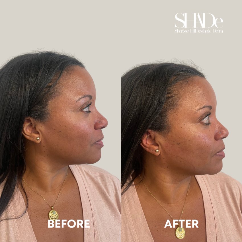 before and after facial treatment at sherisse hill aesthetic dermatology