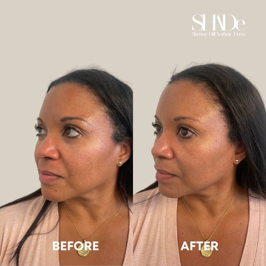 before and after facial treatment at sherisse hill aesthetic dermatology
