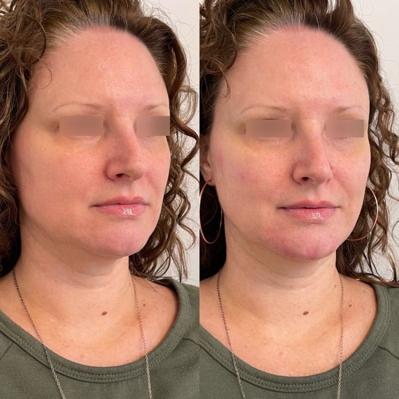 before and after dermal fillers at sherisse hill aesthetic dermatology