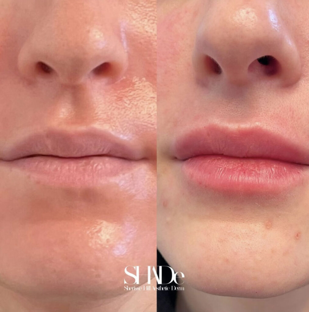 Dermal Fillers Before and After Photo by Sherisse Hill Aesthetic Derm (SHADe) in Issaquah, WA