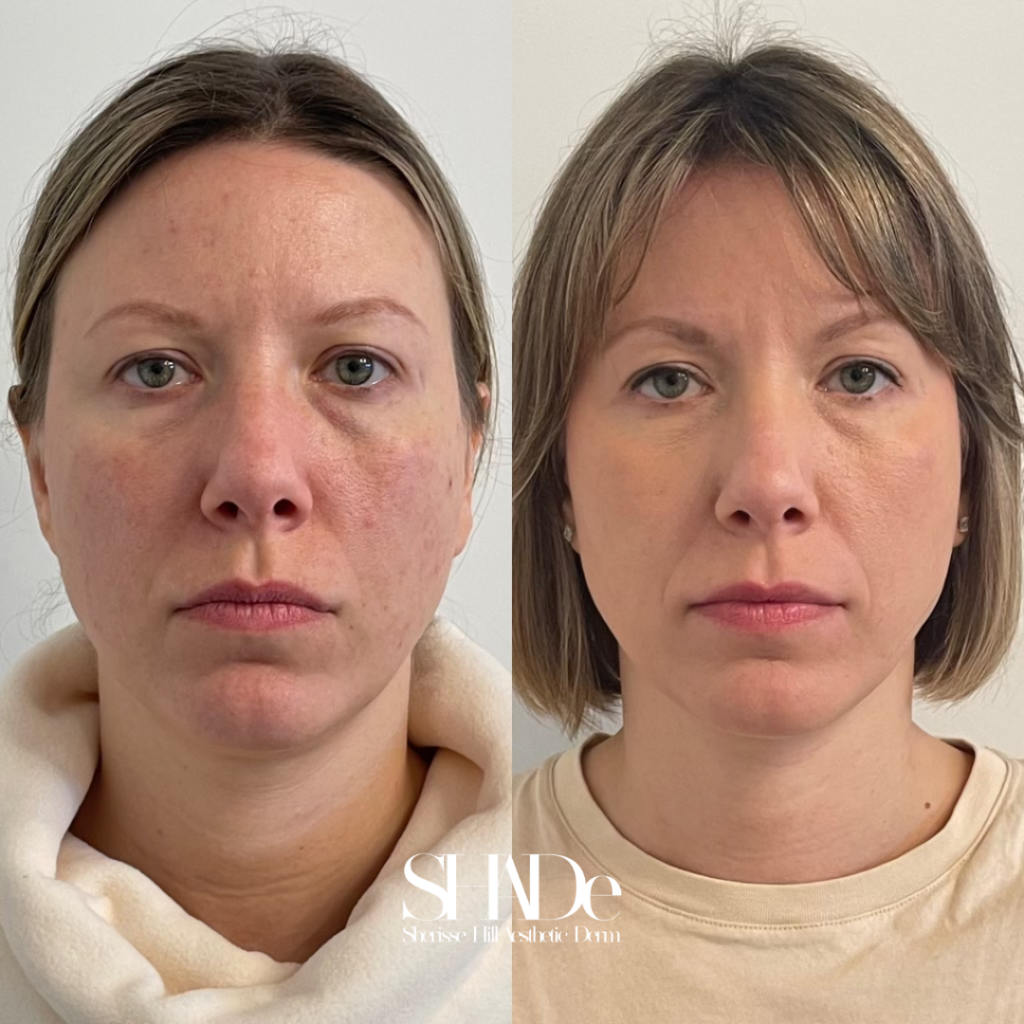 Facial Balancing Before and After Photo by Sherisse Hill Aesthetic Derm (SHADe) in Issaquah, WA