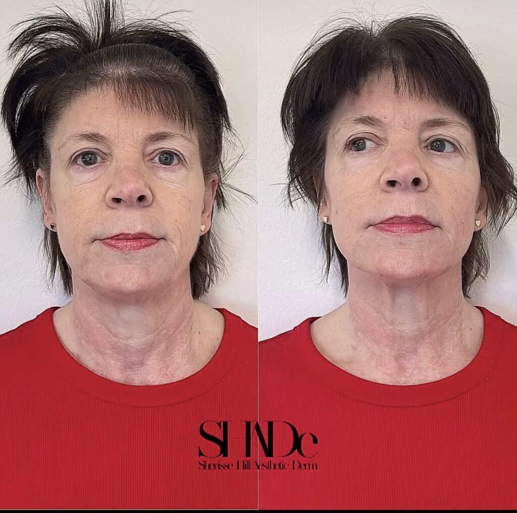 Global Facial Harmonization Before and After Photo by Sherisse Hill Aesthetic Derm (SHADe) in Issaquah, WA