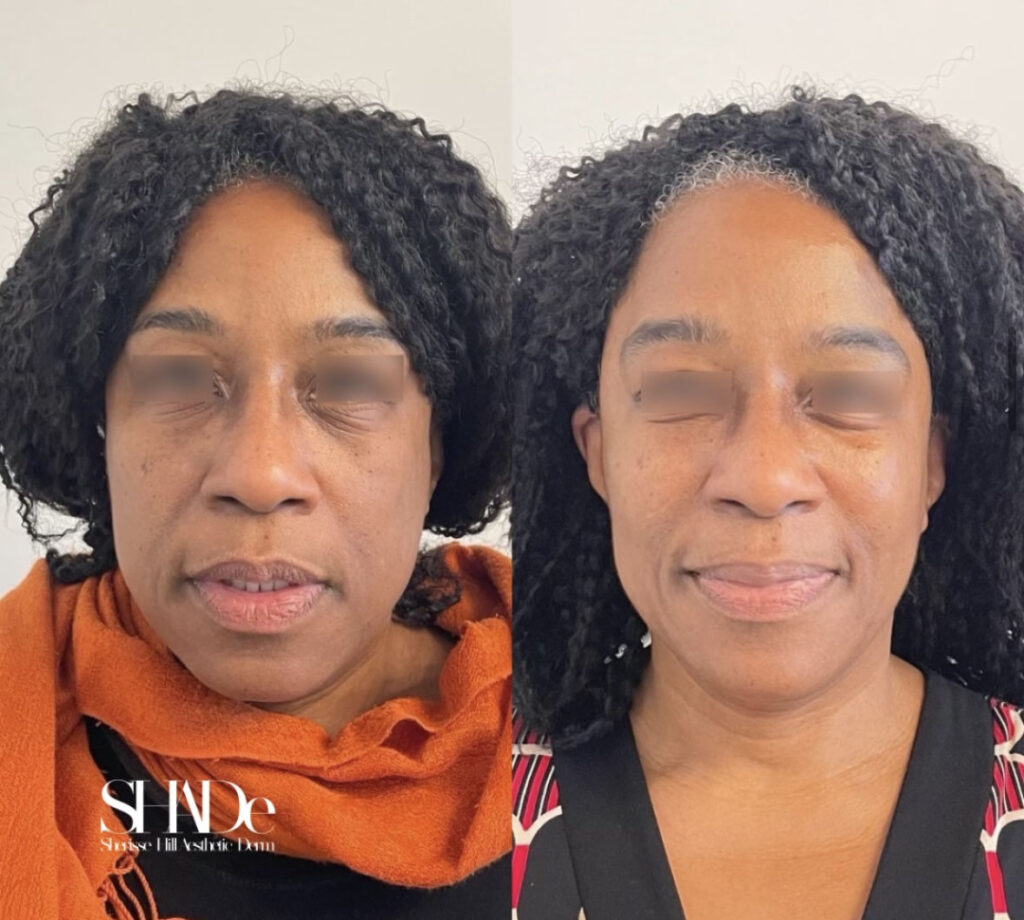 Global Facial Harmonization, Microneedling with BioRePeel Before and After Photo by Sherisse Hill Aesthetic Derm (SHADe) in Issaquah, WA
