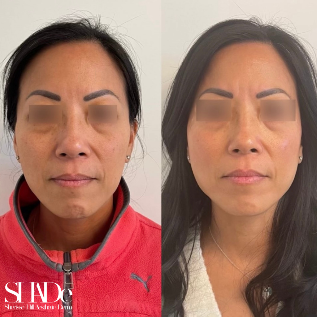 Facial Balancing Before and After Photo by Sherisse Hill Aesthetic Derm (SHADe) in Issaquah, WA