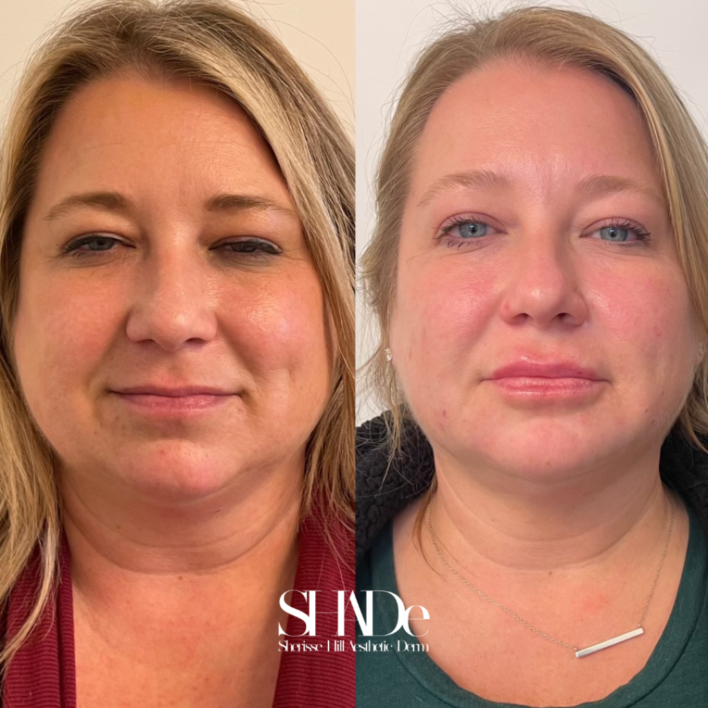 Global Facial Harmonization Before and After Photo by Sherisse Hill Aesthetic Derm (SHADe) in Issaquah, WA
