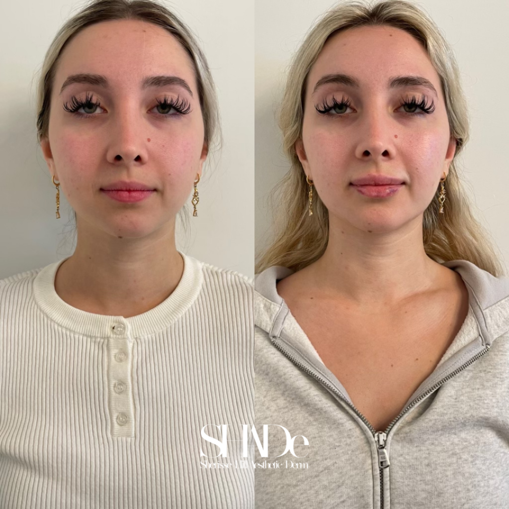 Global Facial Harmonization Before and After Photo by Sherisse Hill Aesthetic Derm (SHADe) in Issaquah, WA