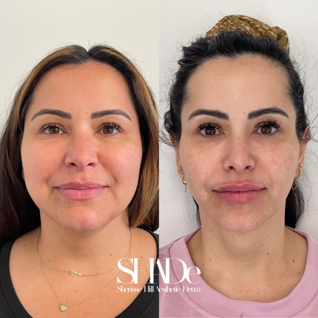 Global Facial Harmonization Before and After Photo by Sherisse Hill Aesthetic Derm (SHADe) in Issaquah, WA