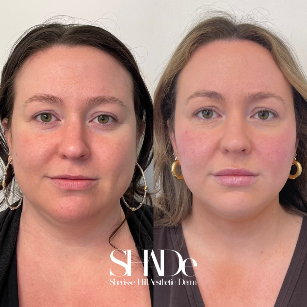 Global Facial Harmonization Before and After Photo by Sherisse Hill Aesthetic Derm (SHADe) in Issaquah, WA