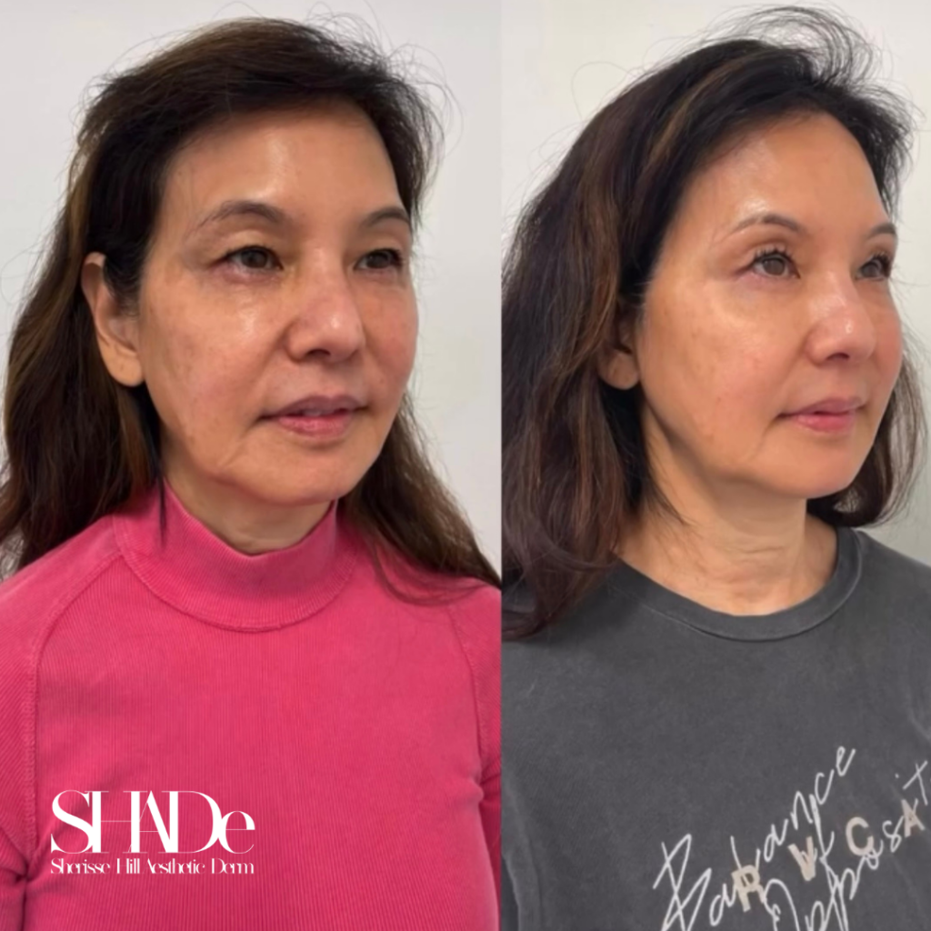 Global Facial Harmonization Before and After Photo by Sherisse Hill Aesthetic Derm (SHADe) in Issaquah, WA