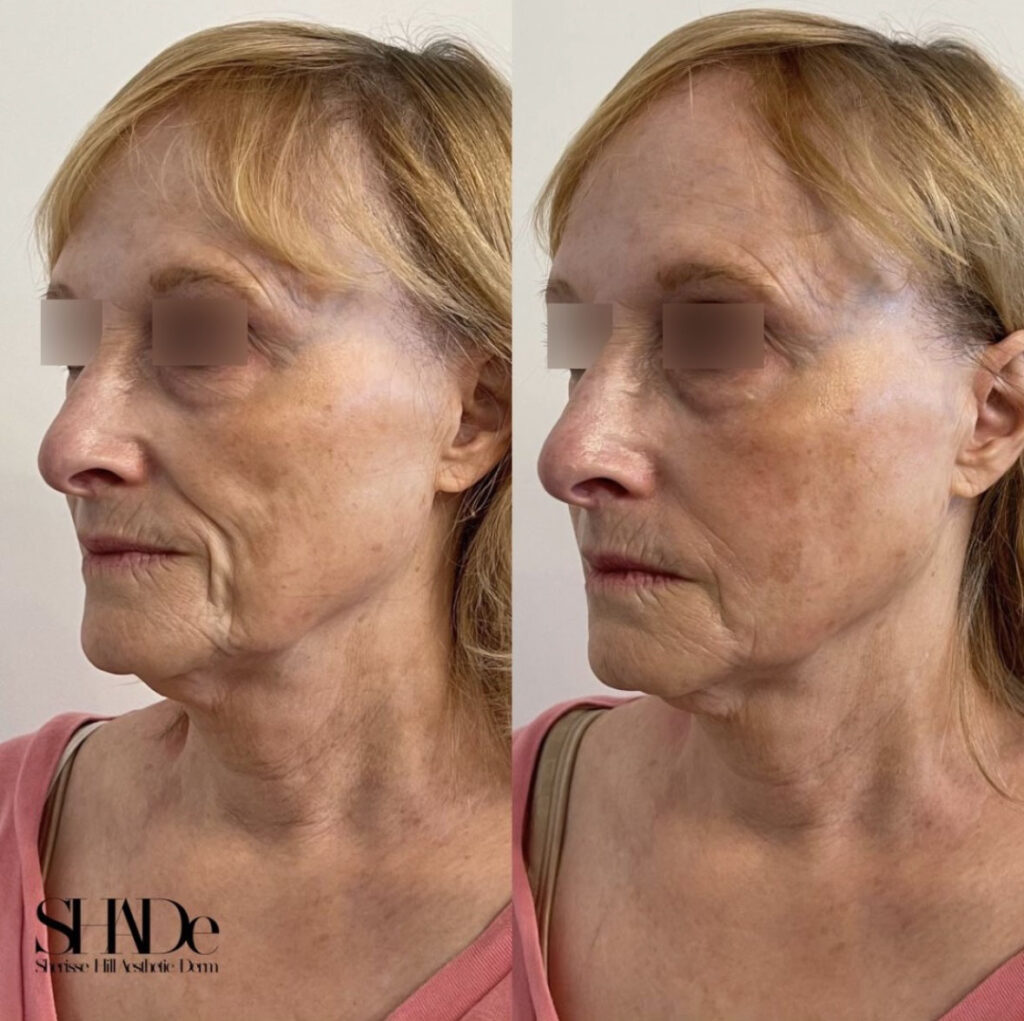 Global Facial Harmonization Before and After Photo by Sherisse Hill Aesthetic Derm (SHADe) in Issaquah, WA