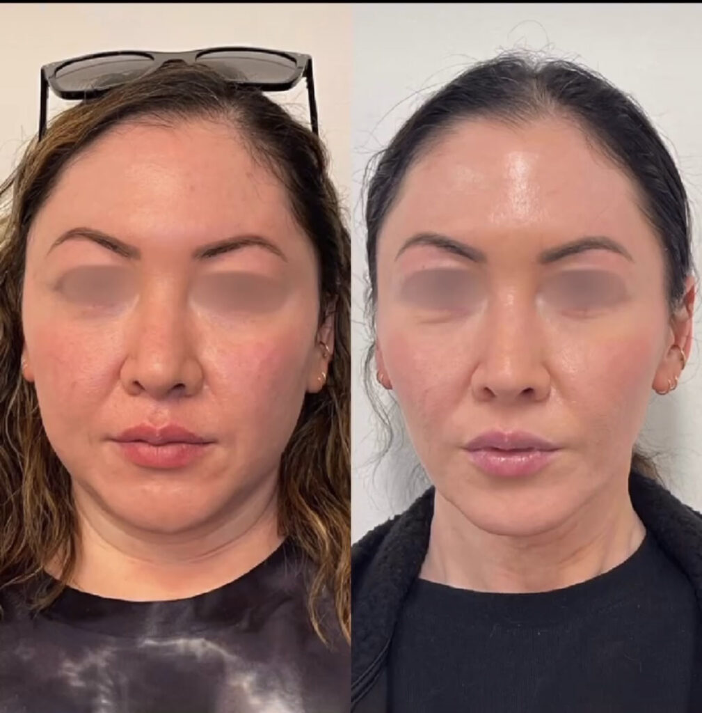 Global Facial Harmonization Before and After Photo by Sherisse Hill Aesthetic Derm (SHADe) in Issaquah, WA