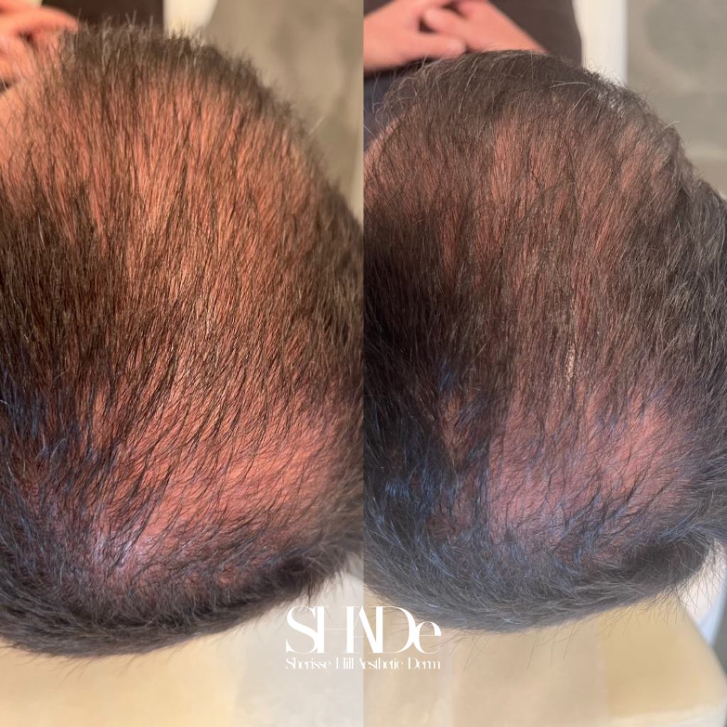PRF Hair Restoration Before and After Photo by Sherisse Hill Aesthetic Derm (SHADe) in Issaquah, WA
