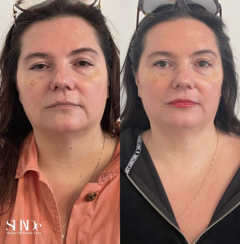 Microneedling with BioRePeel Before and After Photo by Sherisse Hill Aesthetic Derm (SHADe) in Issaquah, WA