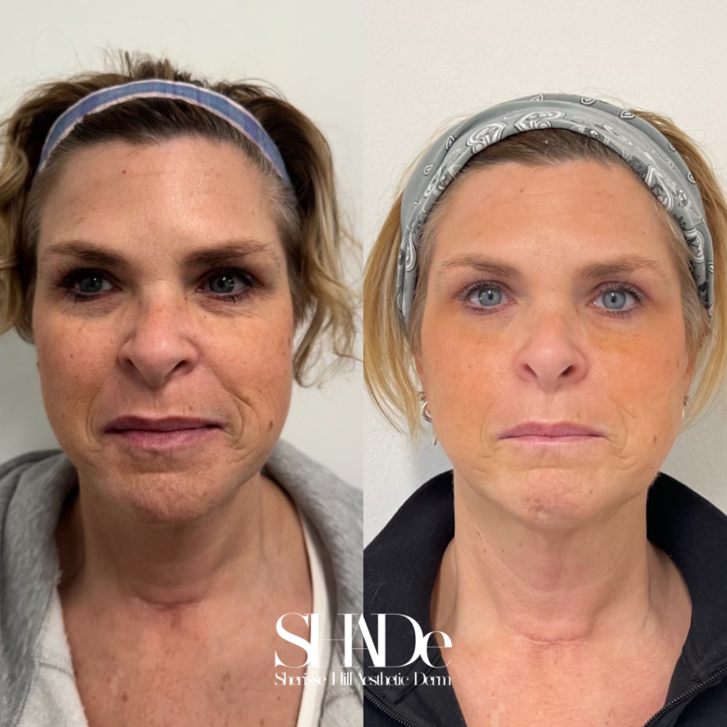 Microneedling with BioRePeel Before and After Photo by Sherisse Hill Aesthetic Derm (SHADe) in Issaquah, WA