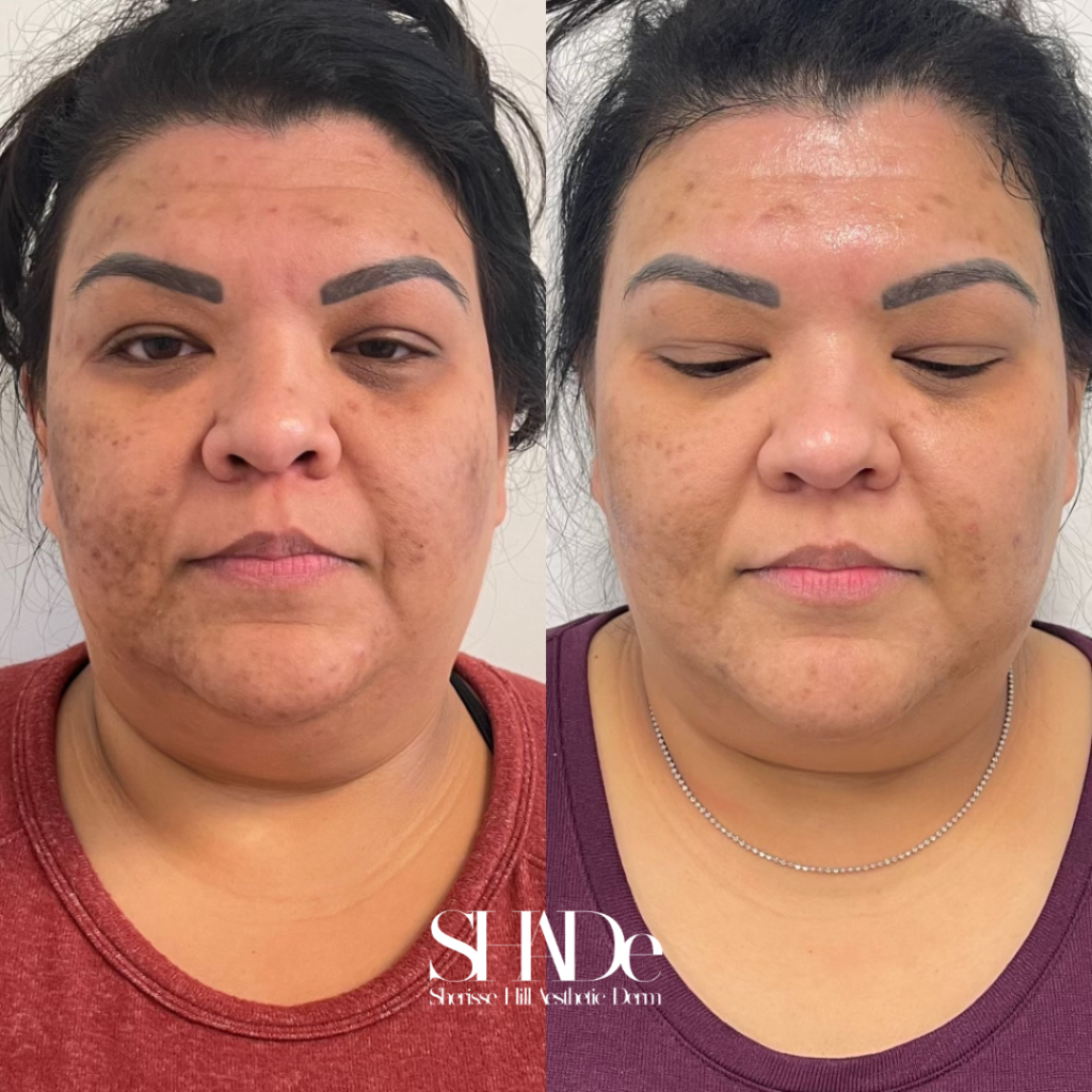 Microneedling with BioRePeel Before and After Photo by Sherisse Hill Aesthetic Derm (SHADe) in Issaquah, WA