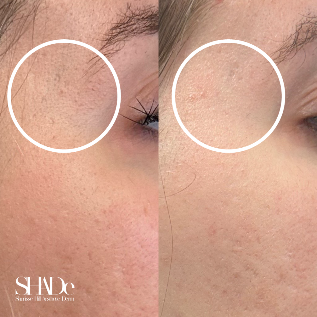 Microneedling with BioRePeel Before and After Photo by Sherisse Hill Aesthetic Derm (SHADe) in Issaquah, WA